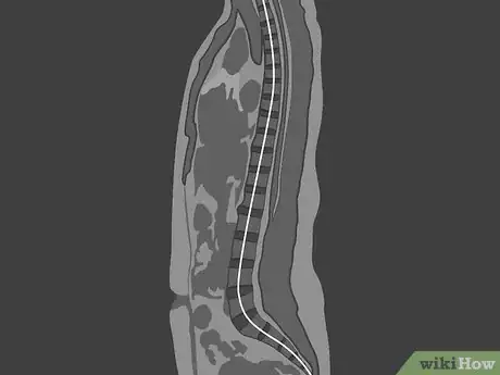 Image titled Read a Lumbar MRI Step 12