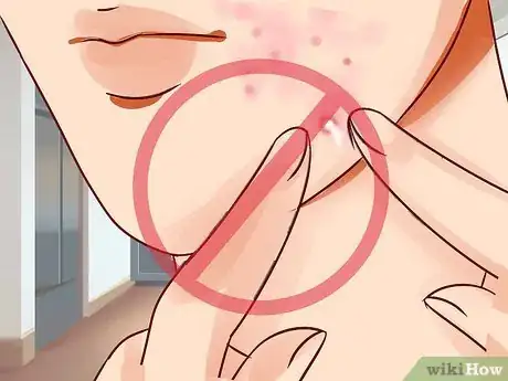 Image titled Get Rid of a Deep Pimple Step 15