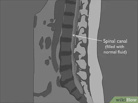 Image titled Read a Lumbar MRI Step 07