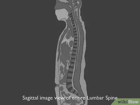 Image titled Read a Lumbar MRI Step 03