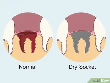 Image titled Prevent Dry Socket After a Tooth Extraction Step 9