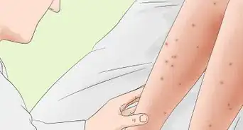 Treat Sandfly Bites