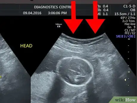 Image titled Read an Ultrasound Picture Step 2