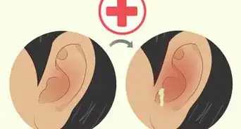 Heal a Ruptured Eardrum