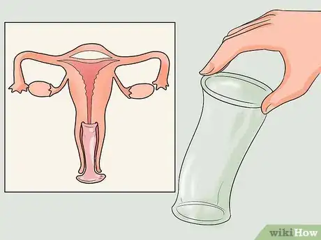 Image titled Recognize Trichomoniasis Symptoms (Women) Step 8