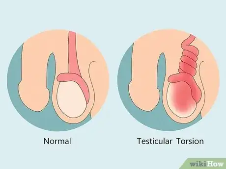 Image titled Treat Pain and Swelling in the Testicles Step 7