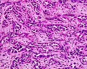 Poor to moderately differentiated adenocarcinoma of the stomach. H&E stain.