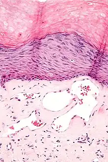 Scrotal angiokeratoma; visible large dilated blood vessels and hyperkeratosis