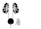 Autosomal dominant polycystic kidney disease