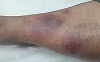 Several lesions of erythema nodosum in an individual with dark skin