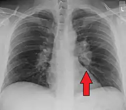 Hilar adenopathy especially on the person's left (AP CXR)