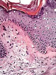 Histopathology of lichen amyloidosis, with subepithelial Congo red-positive deposits