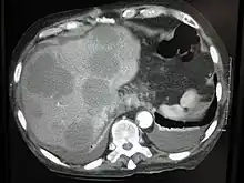 CT image  of multiple liver metastases