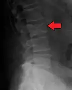 Pathological fracture of the lumbar spine due to multiple myeloma