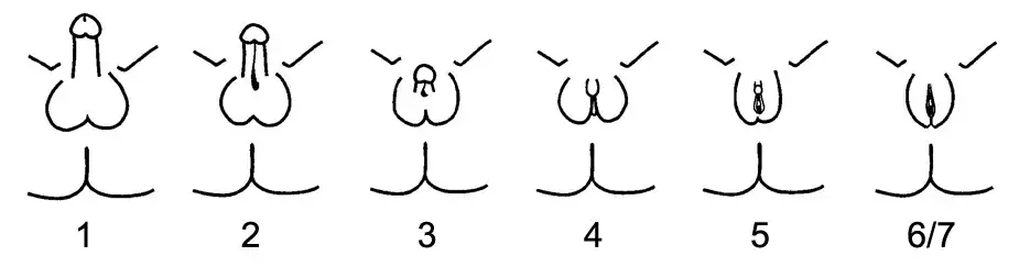 Quigley scale for androgen insensitivity syndrome