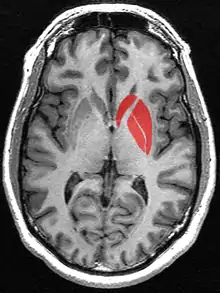 This is a transverse section of the striatum from a structural MR image. The striatum includes the caudate nucleus and putamen. The image also includes the globus pallidus, which is sometimes included when using the term corpus striatum.