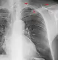 The margins of the supraclavicular fossa are often visible on chest X-ray