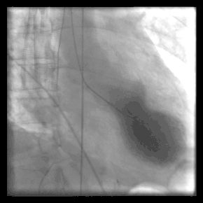 Left ventriculography during systole showing apical ballooning akinesis with basal hyperkinesis in a characteristic takotsubo ventricle