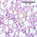 NASH (inflammation) and fibrosis stage 2